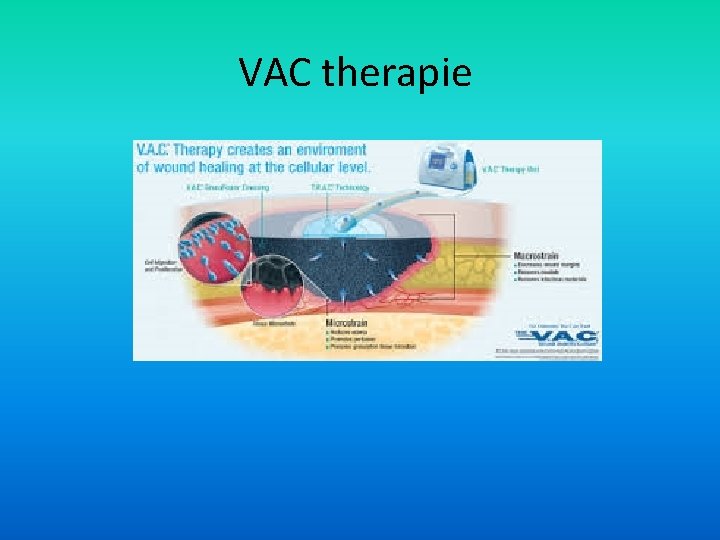 VAC therapie 