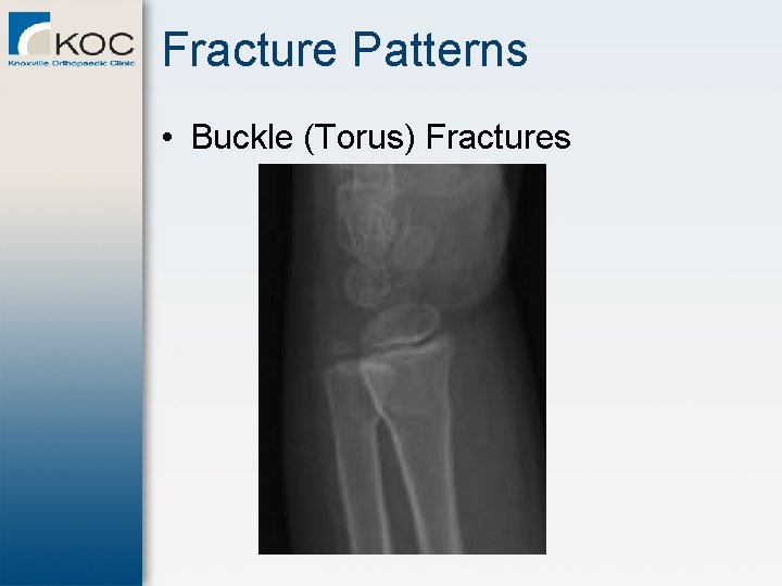 Fracture Patterns • Buckle (Torus) Fractures 
