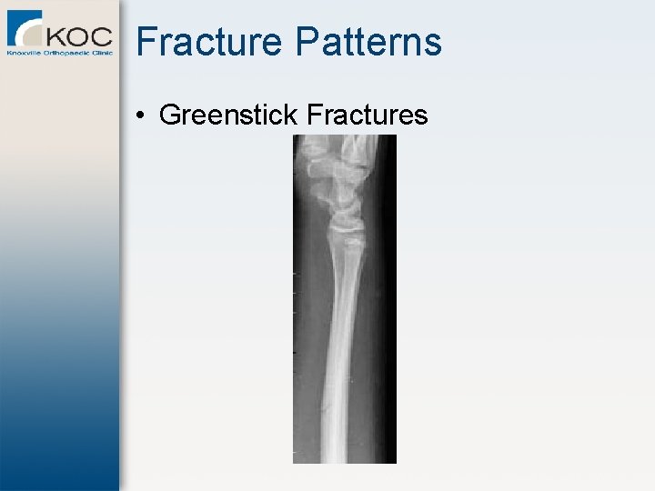 Fracture Patterns • Greenstick Fractures 