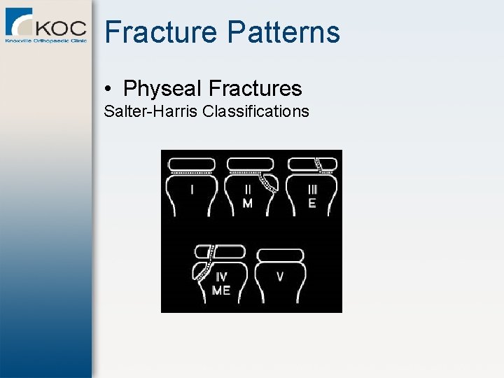 Fracture Patterns • Physeal Fractures Salter-Harris Classifications 