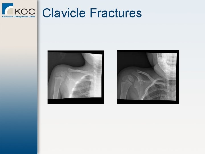 Clavicle Fractures 