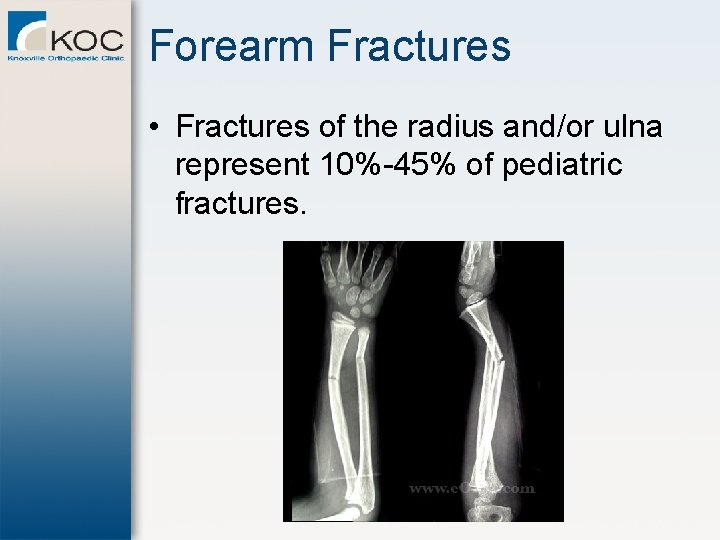 Forearm Fractures • Fractures of the radius and/or ulna represent 10%-45% of pediatric fractures.