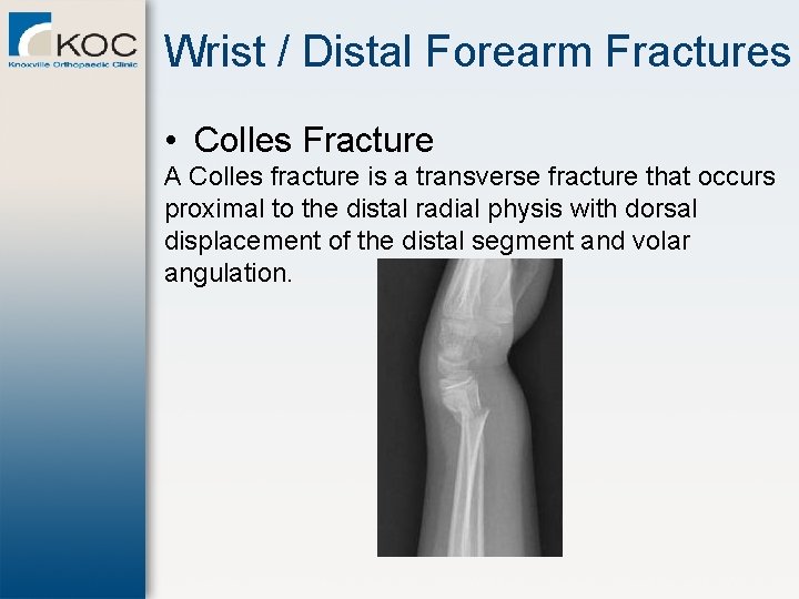 Wrist / Distal Forearm Fractures • Colles Fracture A Colles fracture is a transverse