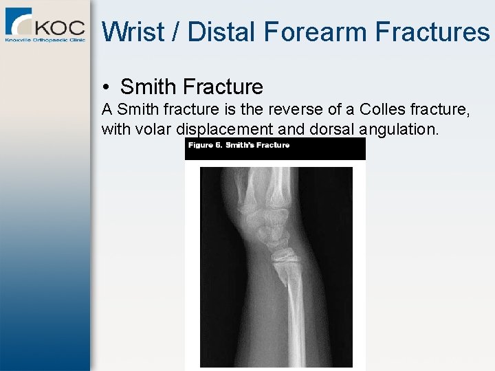 Wrist / Distal Forearm Fractures • Smith Fracture A Smith fracture is the reverse