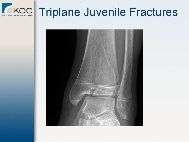 Triplane Juvenile Fractures 