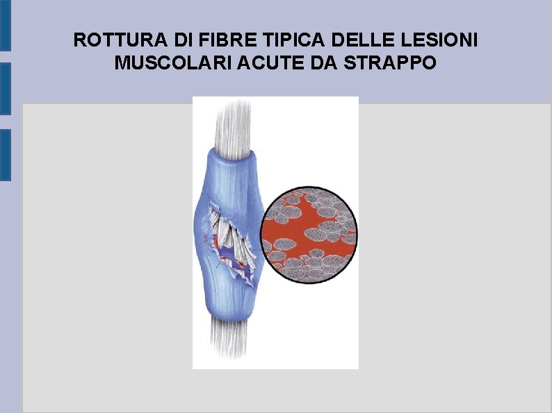 ROTTURA DI FIBRE TIPICA DELLE LESIONI MUSCOLARI ACUTE DA STRAPPO 