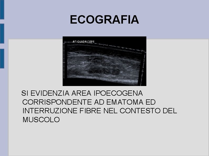 ECOGRAFIA SI EVIDENZIA AREA IPOECOGENA CORRISPONDENTE AD EMATOMA ED INTERRUZIONE FIBRE NEL CONTESTO DEL