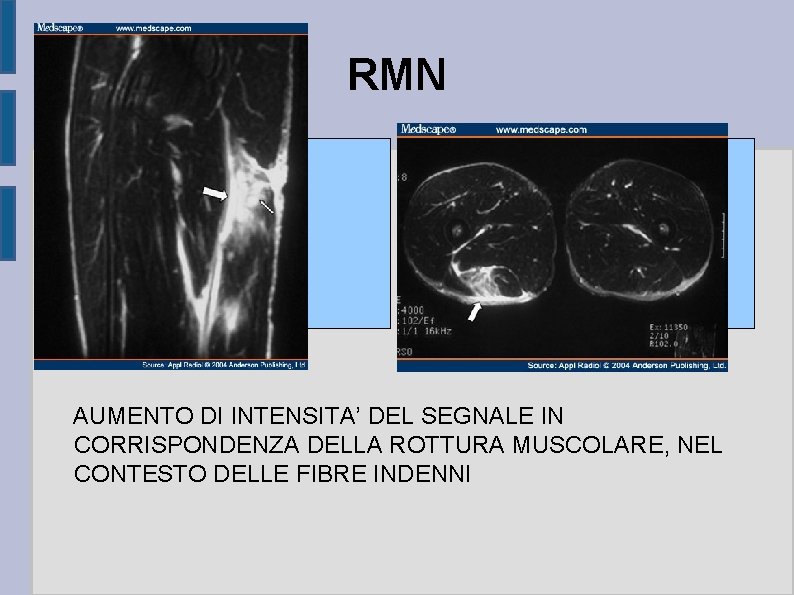 RMN AUMENTO DI INTENSITA’ DEL SEGNALE IN CORRISPONDENZA DELLA ROTTURA MUSCOLARE, NEL CONTESTO DELLE