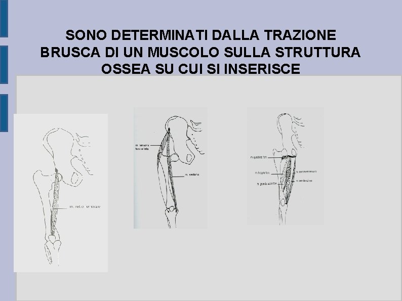SONO DETERMINATI DALLA TRAZIONE BRUSCA DI UN MUSCOLO SULLA STRUTTURA OSSEA SU CUI SI