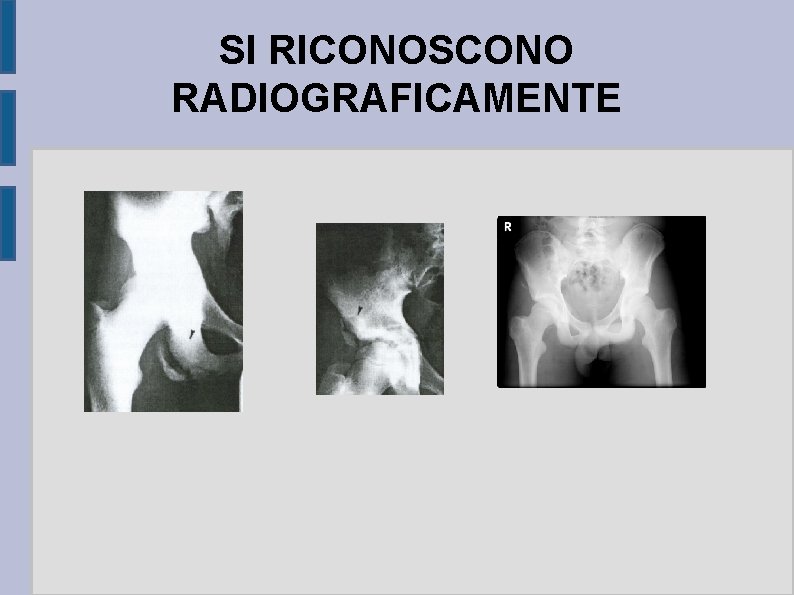 SI RICONOSCONO RADIOGRAFICAMENTE 