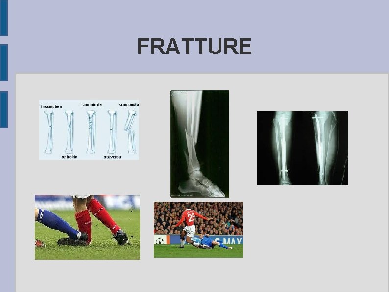 FRATTURE 