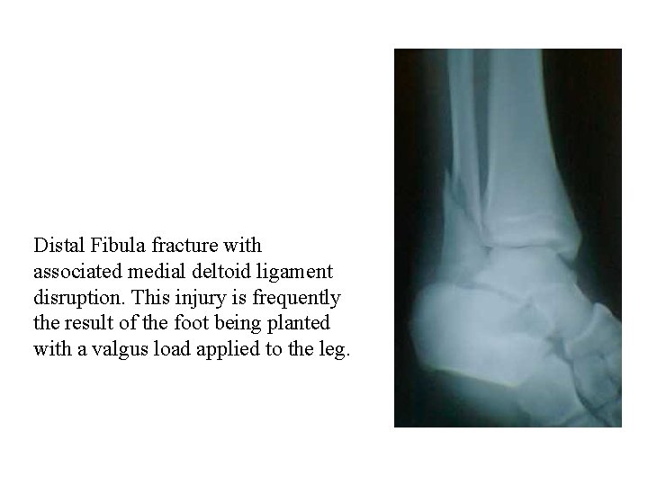 Distal Fibula fracture with associated medial deltoid ligament disruption. This injury is frequently the