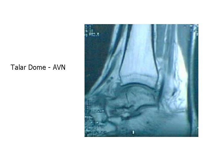 Talar Dome - AVN 