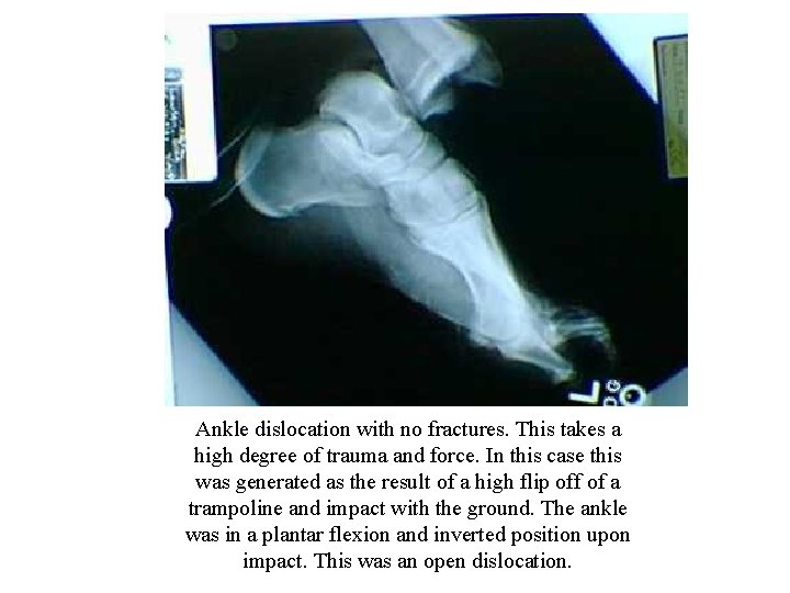  Ankle dislocation with no fractures. This takes a high degree of trauma and