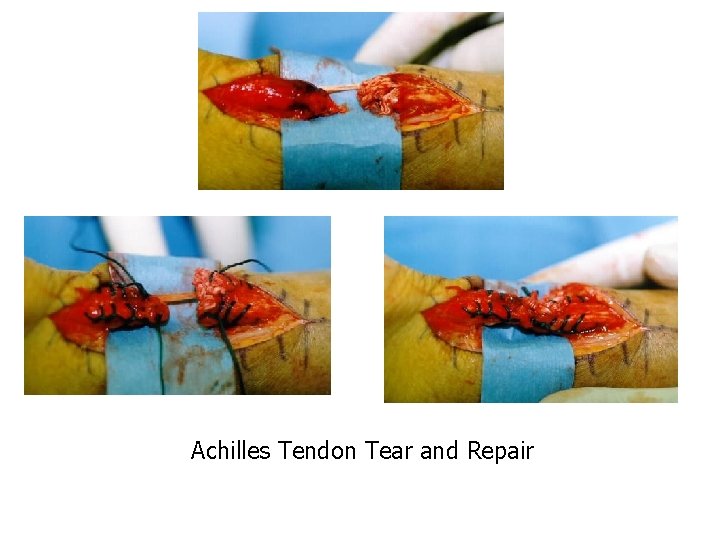 Achilles Tendon Tear and Repair 