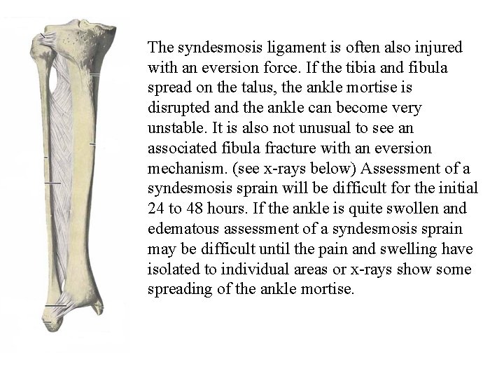 The syndesmosis ligament is often also injured with an eversion force. If the tibia