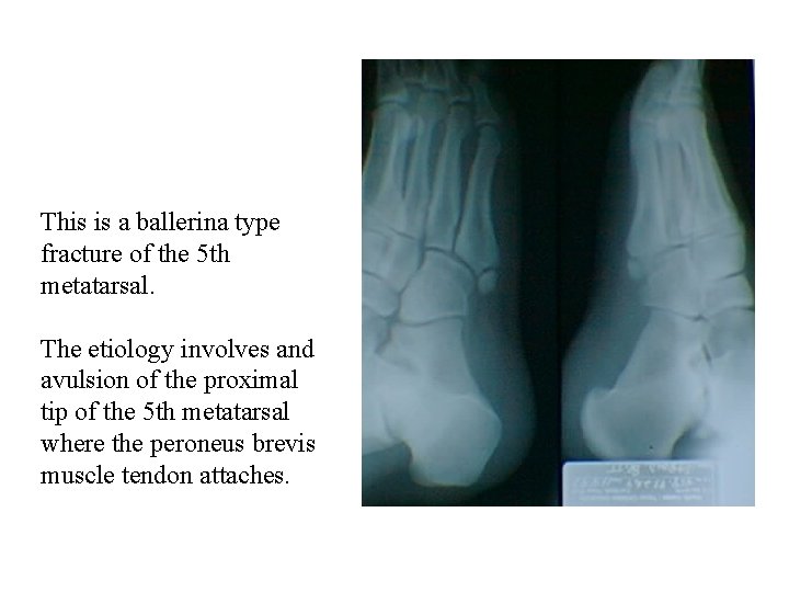 This is a ballerina type fracture of the 5 th metatarsal. The etiology involves
