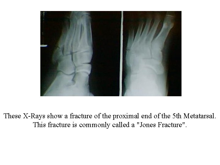 These X-Rays show a fracture of the proximal end of the 5 th Metatarsal.