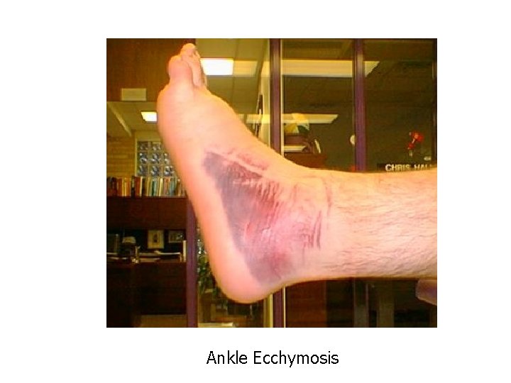 Ankle Ecchymosis 