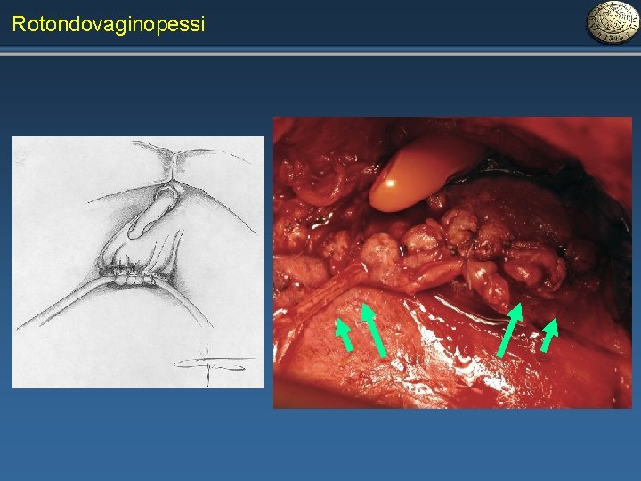 Rotondovaginopessi 