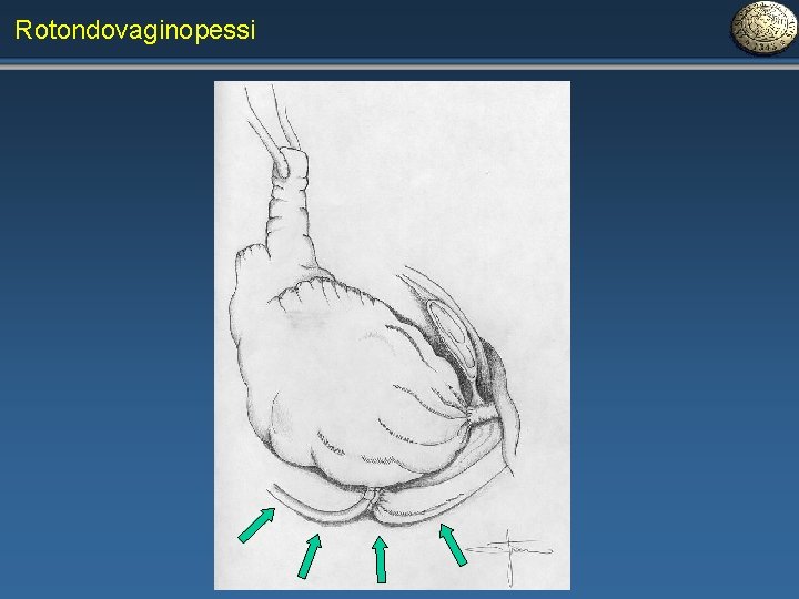 Rotondovaginopessi 