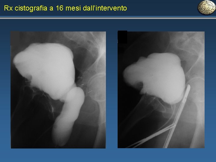 Rx cistografia a 16 mesi dall’intervento 