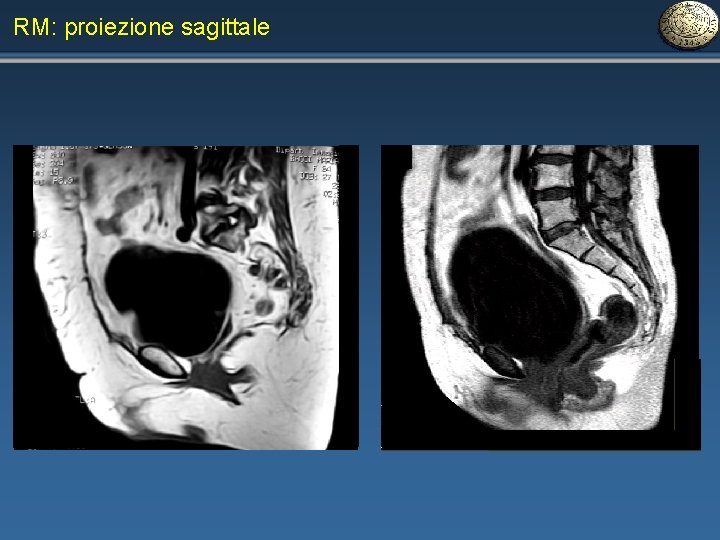 RM: proiezione sagittale 