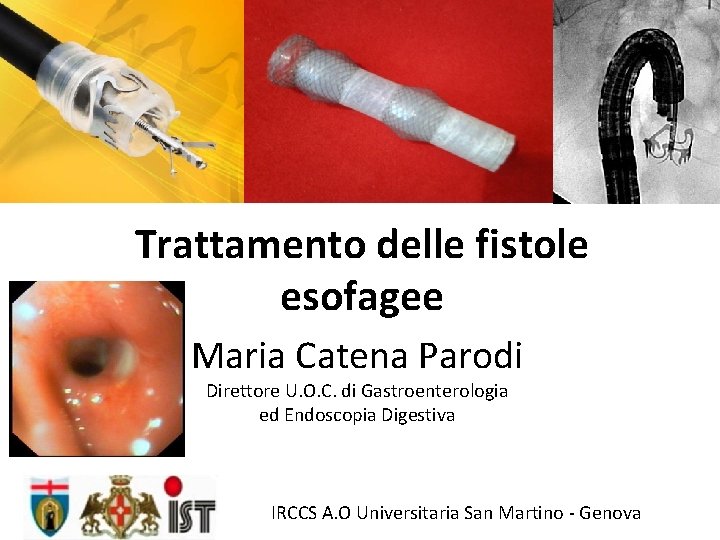 Trattamento delle fistole esofagee Maria Catena Parodi Direttore U. O. C. di Gastroenterologia ed