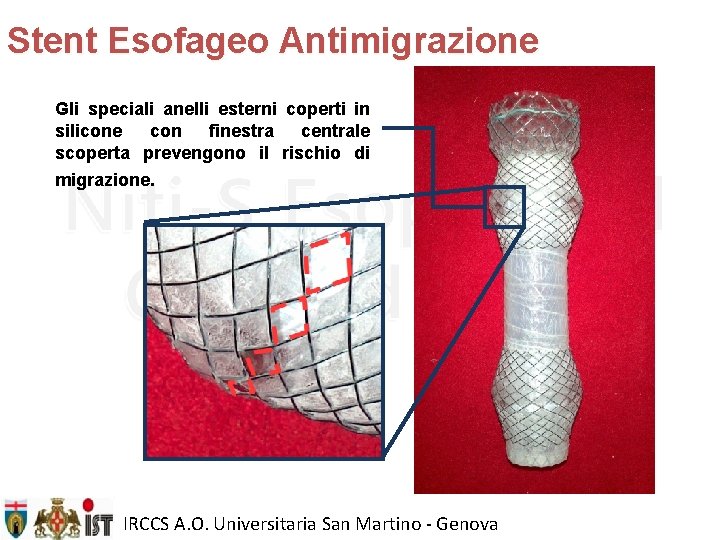 Stent Esofageo Antimigrazione Gli speciali anelli esterni coperti in silicone con finestra centrale scoperta