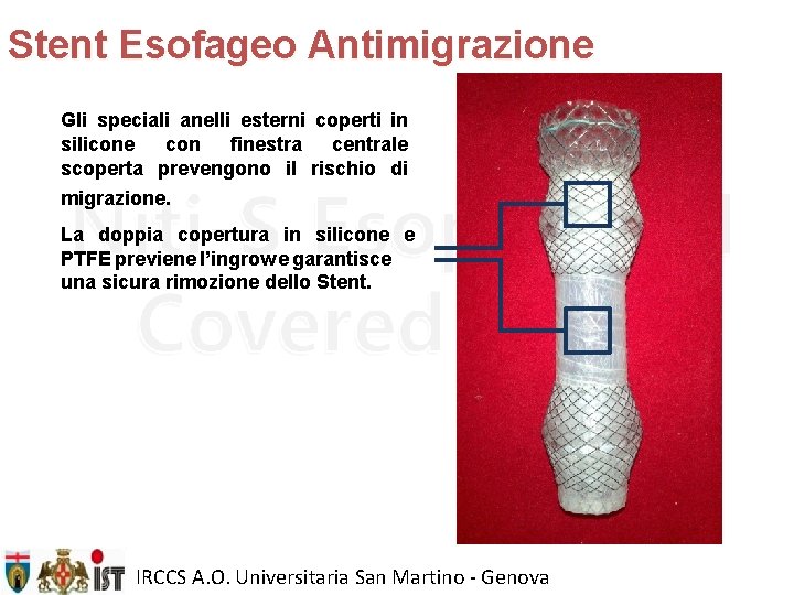 Stent Esofageo Antimigrazione Gli speciali anelli esterni coperti in silicone con finestra centrale scoperta