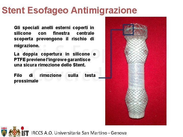 Stent Esofageo Antimigrazione Gli speciali anelli esterni coperti in silicone con finestra centrale scoperta