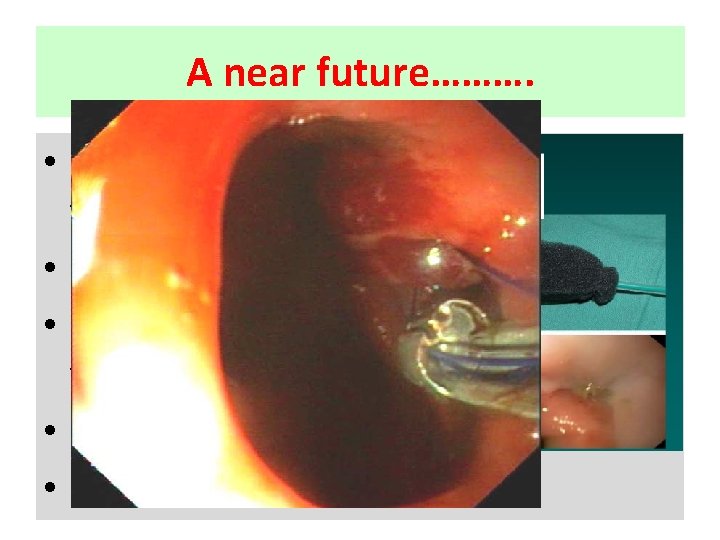 A near future………. • Collagen matrix on the outside of the stent • Biodegredable