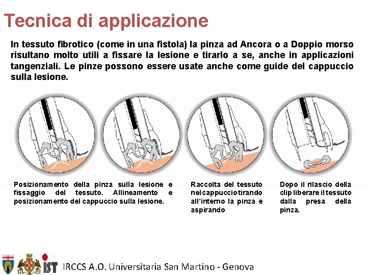 Tecnica di applicazione In tessuto fibrotico (come in una fistola) la pinza ad Ancora