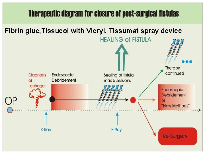 Fibrin glue, Tissucol with Vicryl, Tissumat spray device 
