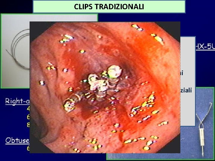CLIPS TRADIZIONALI LIMITI DI APPLICAZIONE • • Scarsa forza nella presa dei tessuti Utili