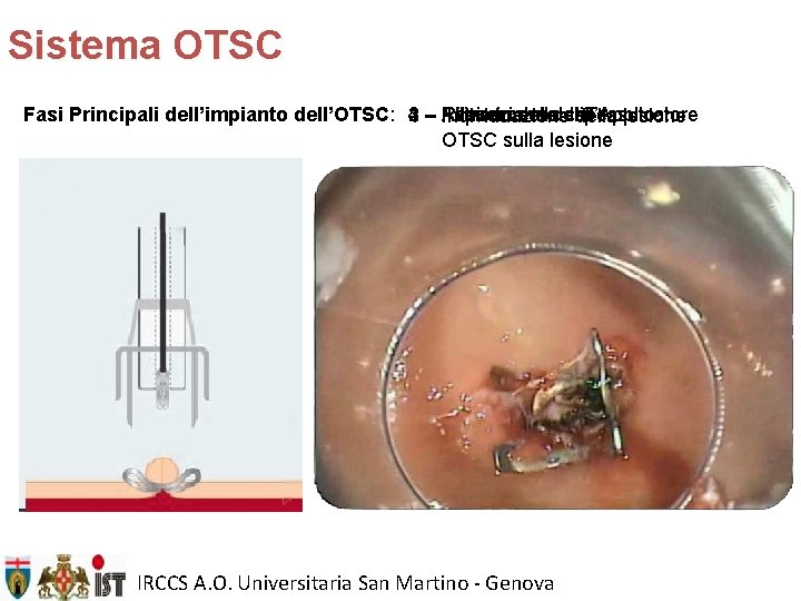 Sistema OTSC Fasi Principali dell’impianto dell’OTSC: 4 3 – Rilascio Aspirazione delladel clip Tessuto