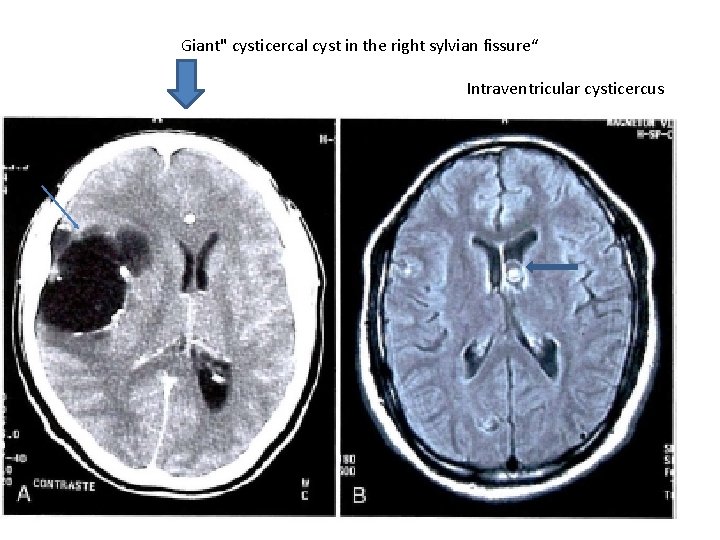 Giant" cysticercal cyst in the right sylvian fissure“ Intraventricular cysticercus 