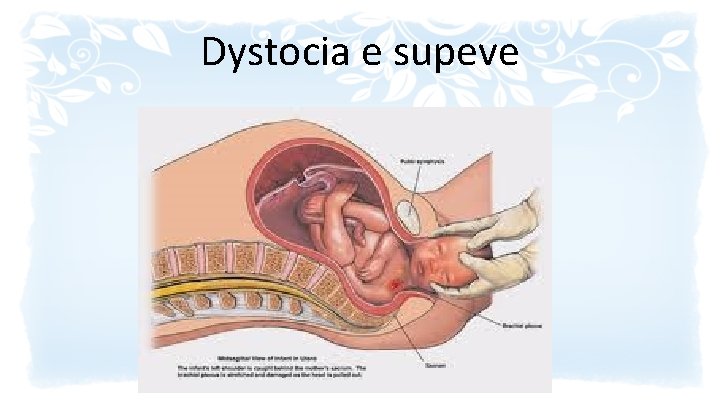 Dystocia e supeve 