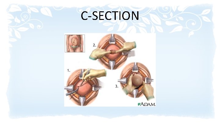 C-SECTION 