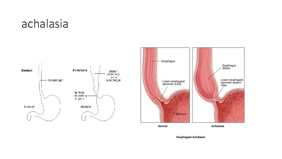 achalasia 