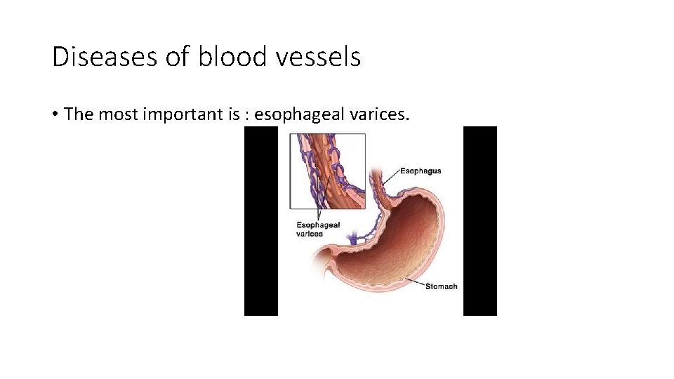 Diseases of blood vessels • The most important is : esophageal varices. 