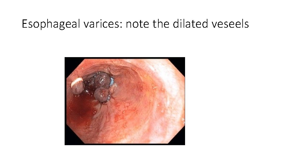 Esophageal varices: note the dilated veseels 