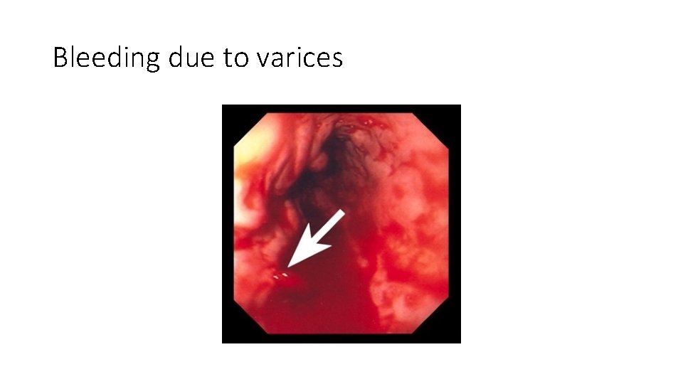 Bleeding due to varices 