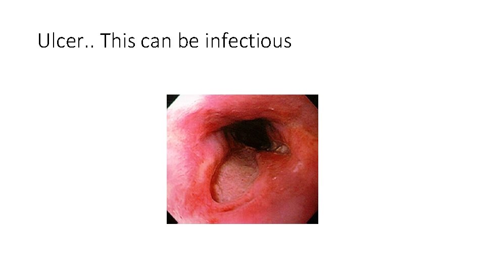 Ulcer. . This can be infectious 