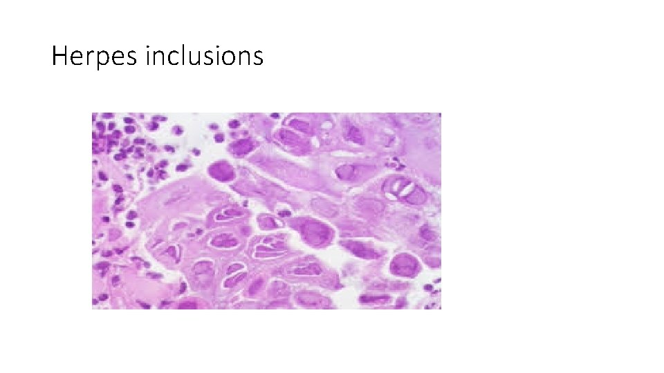 Herpes inclusions 