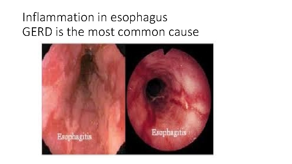 Inflammation in esophagus GERD is the most common cause 