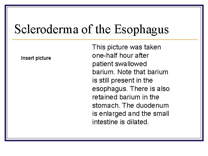 Scleroderma of the Esophagus Insert picture This picture was taken one-half hour after patient