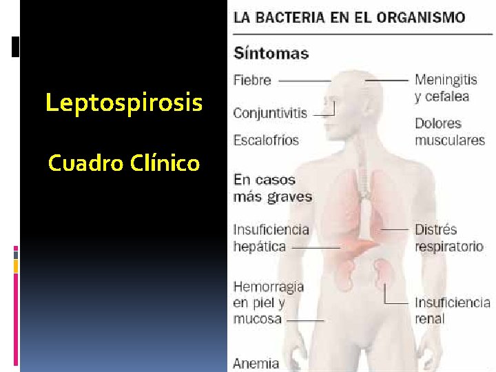 Leptospirosis Cuadro Clínico 