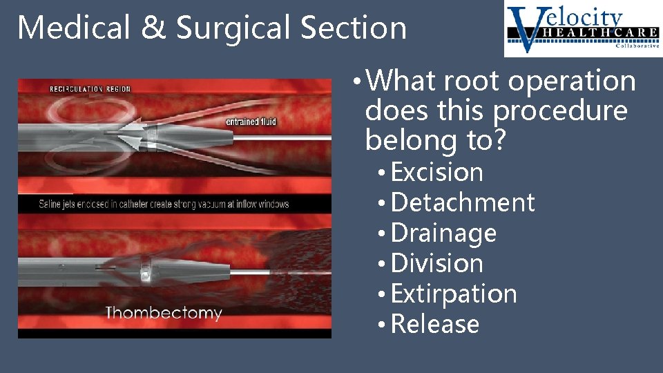 Medical & Surgical Section • What root operation does this procedure belong to? •