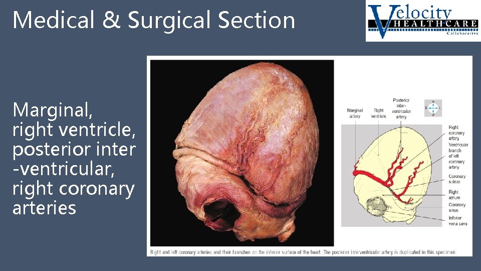 Medical & Surgical Section Marginal, right ventricle, posterior inter -ventricular, right coronary arteries 